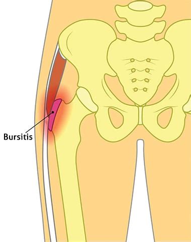 Image Result For Trochanteric Bursitis Bursitis Hip Trochanteric My