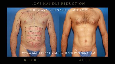 Love Handles Before After Images Male Love Handles Image
