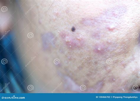 Lesions Skin Caused By Acne On The Face In The Clinic Stock Photo