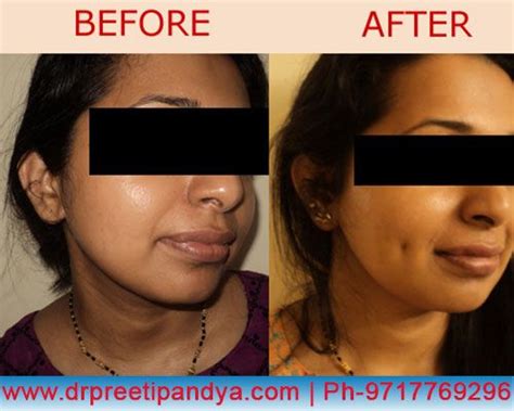 Dimple Creation Surgery Indiacost Dimple Creation Surgery Delhidimple Creation Surgery Cost In