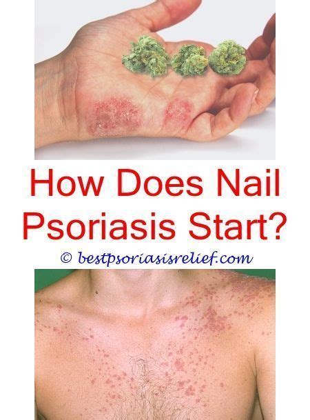 Pin By Jina On Health Nail Psoriasis Treatment Foot Remedies