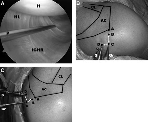The Axillary Pouch Portal A New Posterior Portal For Visualization And