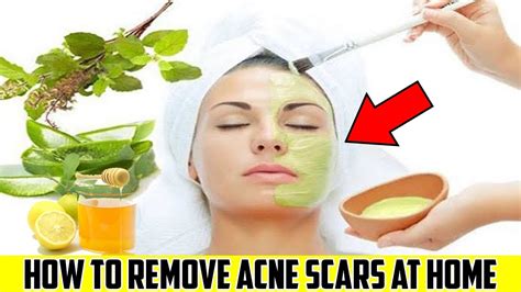 Acne Home Remedies Acne Home Treatment Loan Nguyen Acne Treatment