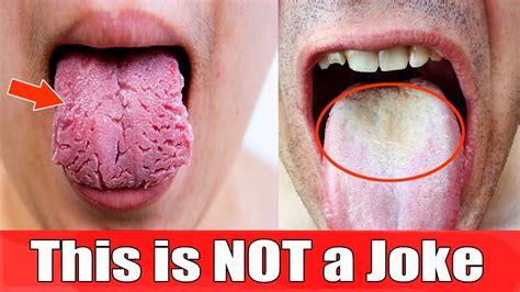 What Causes White Tongue Fastest Way To Get Rid Of White Tongue Bad