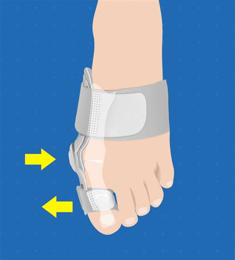 Hallux Valgus Corrector With Joint Abu Lail Medical And Sport Center