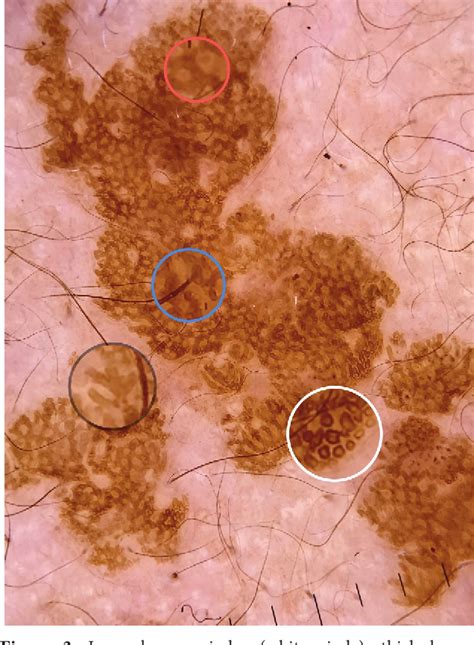 Pdf Dermoscopic Aspect Of Verrucous Epidermal Nevi New Findings