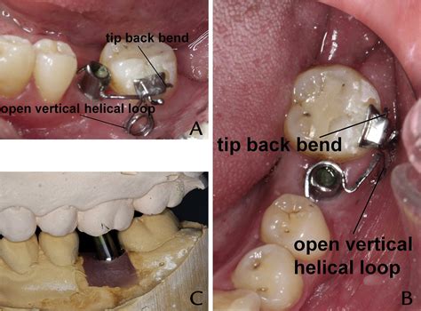 Uprighting A Mesially Tilted Mandibular Left Second Molar With