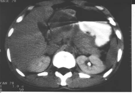 Ct Features In Abdominal Tuberculosis 20 Years Experience Bmc