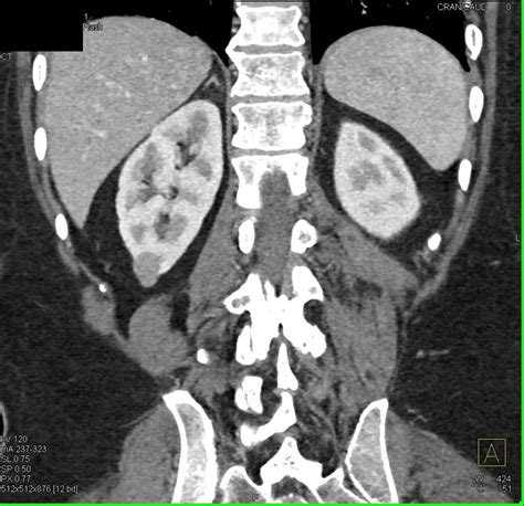 Complex Cyst Lower Pole Right Kidney Kidney Case Studies Ctisus Ct
