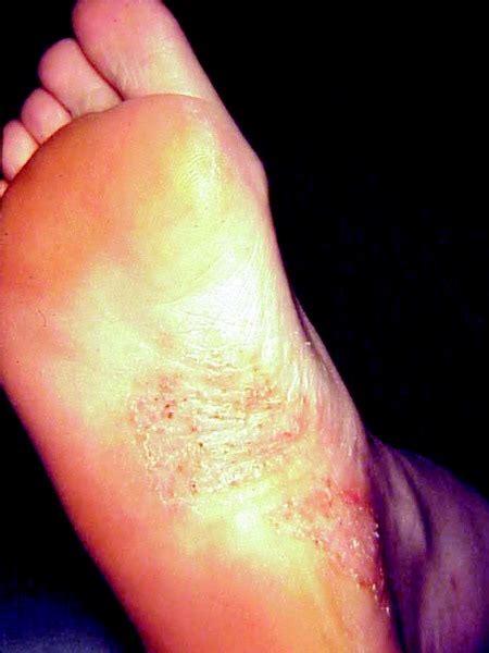 Discover More Than 138 Slipper Marks On Feet Best Esthdonghoadian