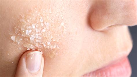 4 Steps To Getting Rid Of A Cystic Pimple Fast Allure