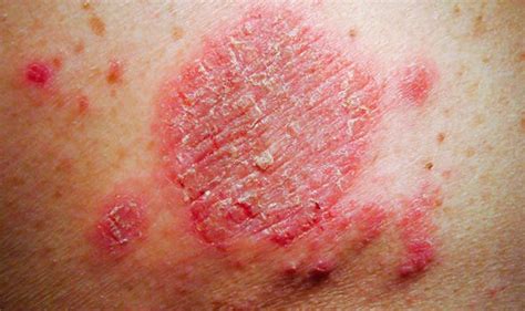 Eczema Do You Have Coin Shaped Spots On Your Body It Could Be