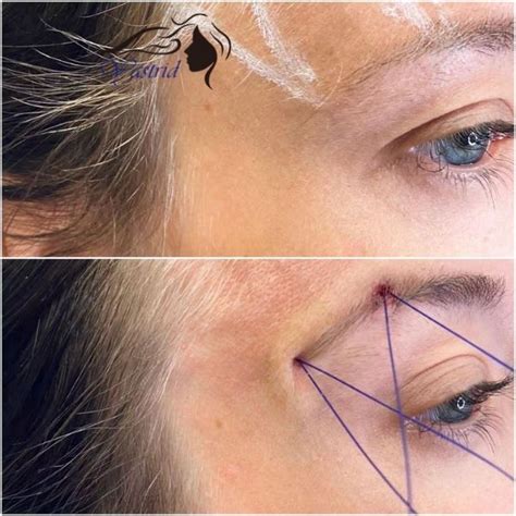What To Expect After A Thread Brow Lift Yastrid Medical Aesthetic