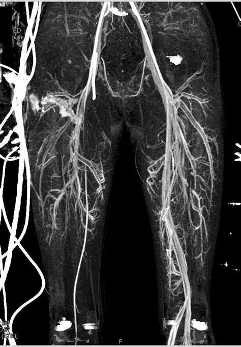 Vascular Injury Left Femoral Artery Vascular Case Studies Ctisus Ct