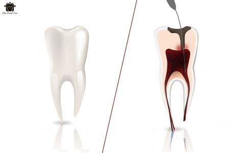 how to know if you need a root canal elite dental care tracy