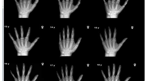 Hand Wrist Radiography I Dental Guide I Dr Bimal Chand I Youtube