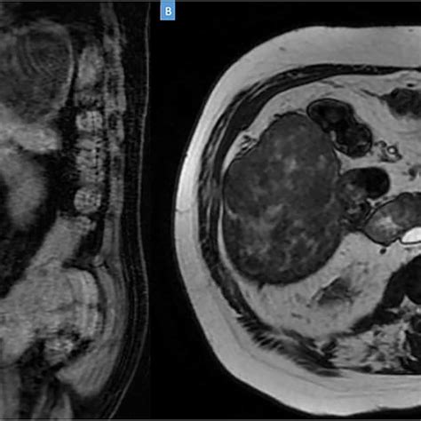 Coronal A And Axial B Sections Of Mri Showing The Peripheral Liver