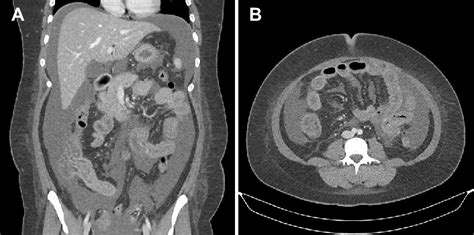 Abdominal Computed Tomography Showing A Massive Amount Of Ascites And