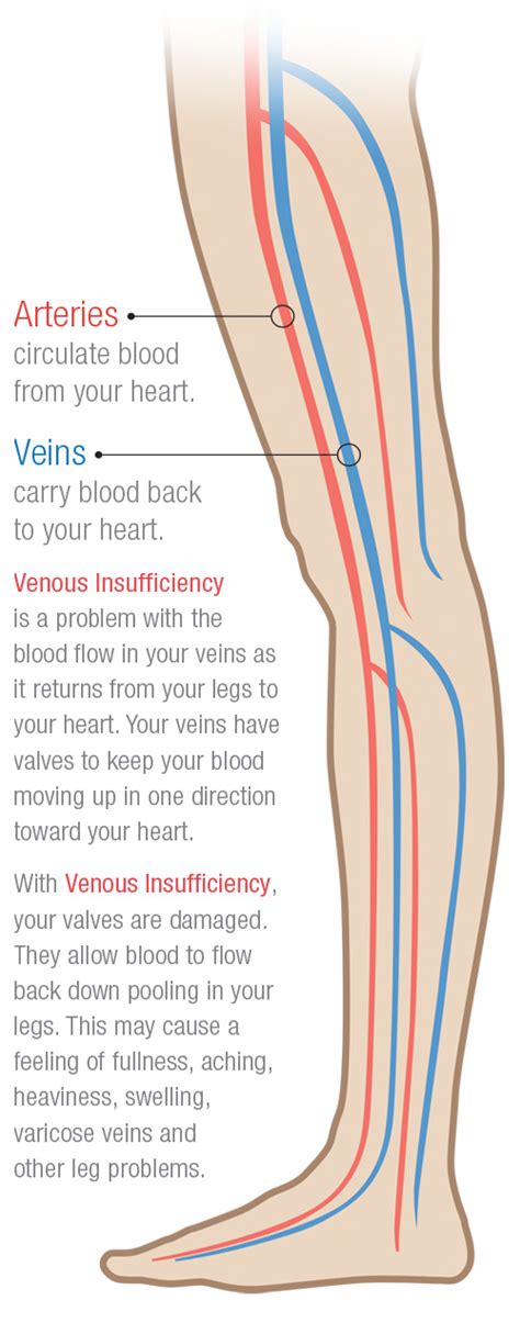 Venous Insufficiency Vein Conditions Triangle Vein Clinic Cary Nc