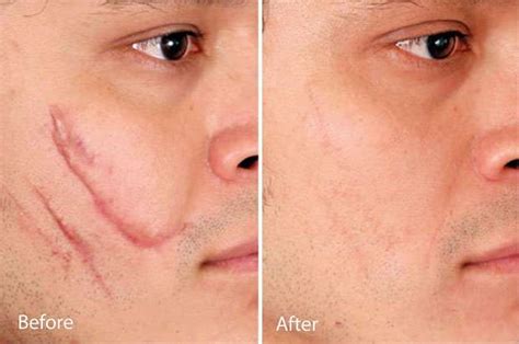 How To Remove Scars Scar Removal That Works Dubai Laser Treatment