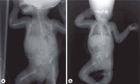 Figure 1 From An Acute Complication Of Ventriculoperitoneal Shunt With Bladder Perforation And