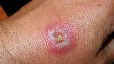Hobo Spider Bite Pictures Symptoms And Treatments The Art Of Mike