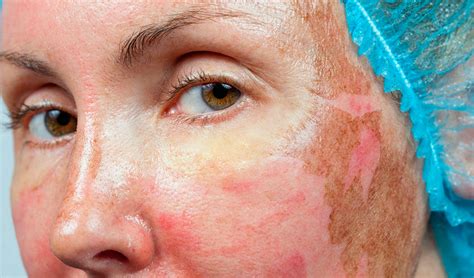 Peeling Facial Tipos Y Resultados De Este Tratamiento Dermatológico