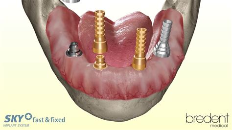 Sky Fast And Fixed Implant System 3d Animation Youtube