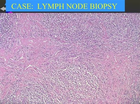 10lymphoma Final Year Ppt