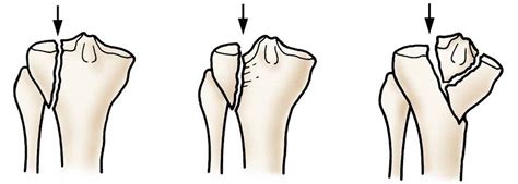 Tibial Plateau Fracture Symptoms Causes Treatment And Rehabilitation
