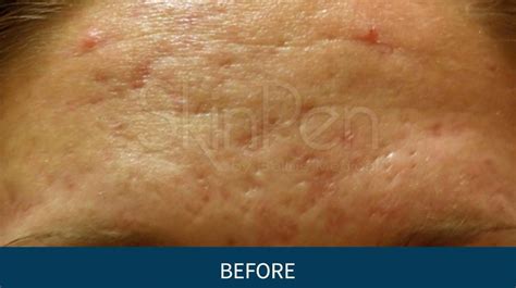 Acne Scar Removal Woodlands Tx Woodlands Wellness And Cosmetic Center