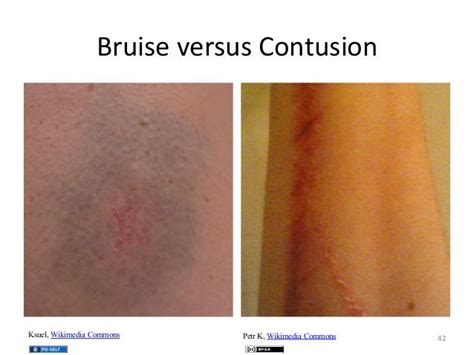 Contusion Vs Hematoma