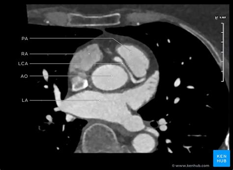 Abnormal Left Coronal Artery Case And Images Kenhub