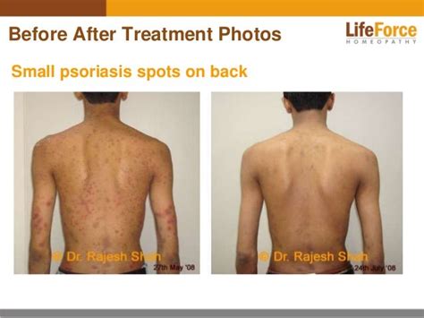 Psoriasis On Back Photos Before After Treatment Pictures Of Patients