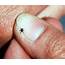 Upstate Lyme Disease Doctor Early Treatment Crucial But Diagnosis Can 