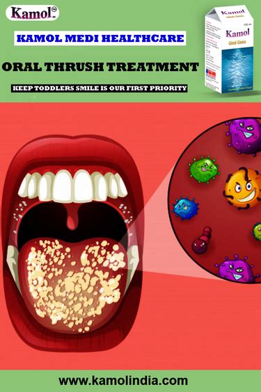 Oral Thrush Causes Symptoms And Treatment Kamol Oral Care