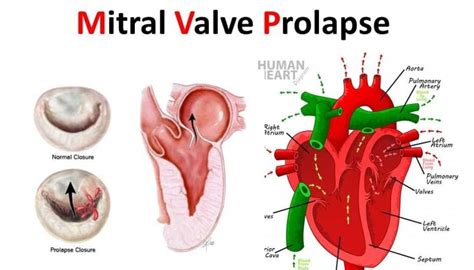 Mitral Valve Prolapse What You Must Know Dr Sarat