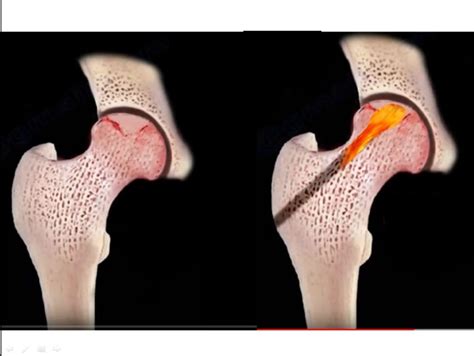 Avascular Necrosis Of The Femoral Head Orthopaedicprinciples Com