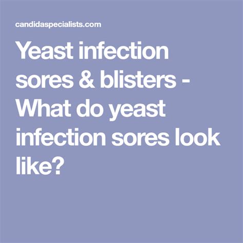 New What Does A Male Yeast Infection Look Like
