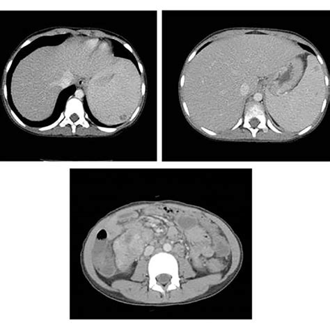 Images Of Computed Tomography Scan Of Abdomen Showing Splenomegaly With