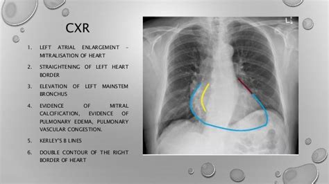 Mitral Stenosis X Ray Findings