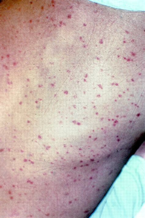 Scrub Typhus Causes Symptoms Diagnosis Treatment And Prognosis