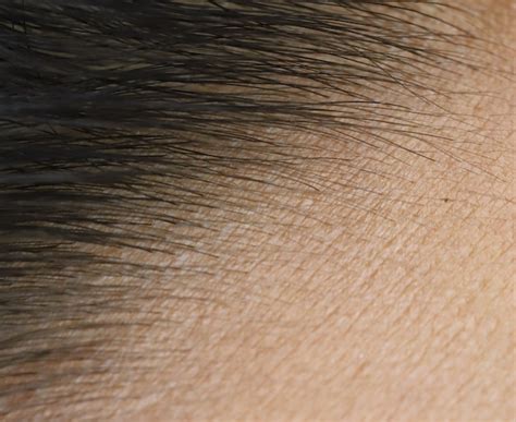 Premium Photo Close Up Skin Of Forehead And Hair