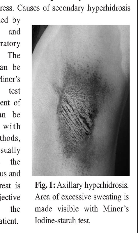 Figure 1 From Treatment Of Hyperhidrosis With Botulinum Toxin A