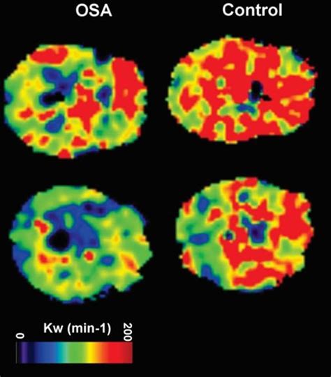 How Obstructive Sleep Apnea Damages The Brain Neuroscience News