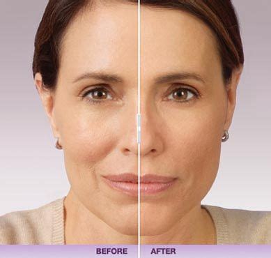 Sample Of Before And After Juvederm Anti Aging Procedures Cosmetic