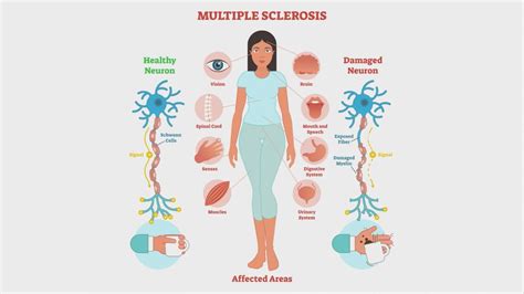 Multiple Sclerosis Symptoms And 4 Ultimate Causes