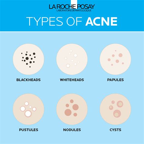 Difference Between Acne Vs Pimples La Roche Posay® Australia And Nz