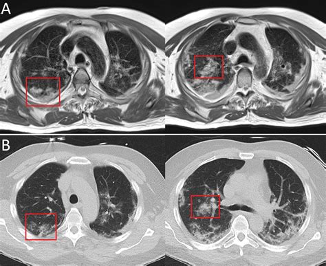 High Performance 055 T Lung Mri In Patient With Covid 19 Infection