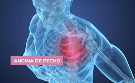 Angina De Pecho Conoce Síntomas Y Causas De Esta Enfermedad